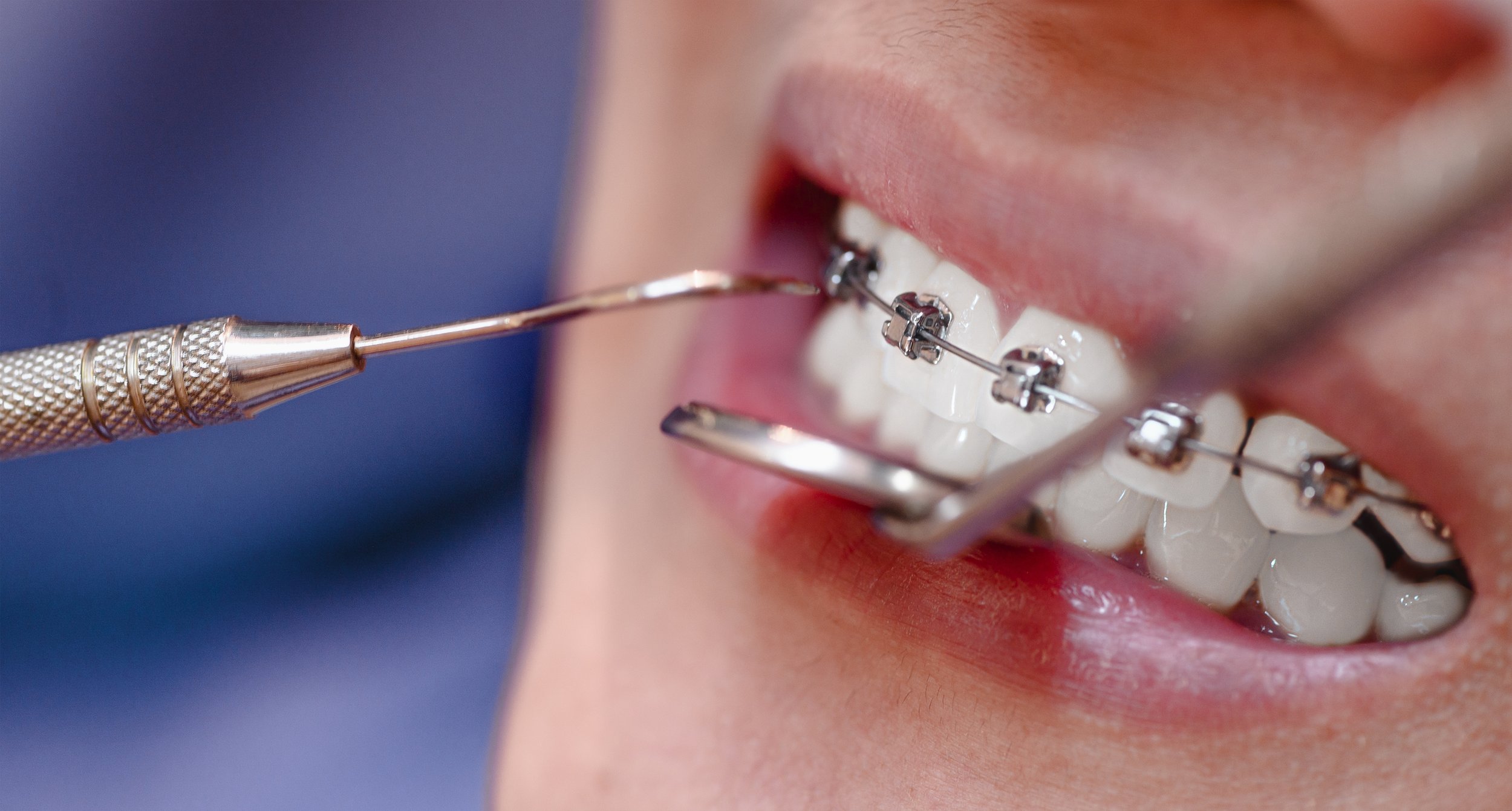 Procedimiento dental con brackets y instrumentos metálicos en la boca de un paciente.