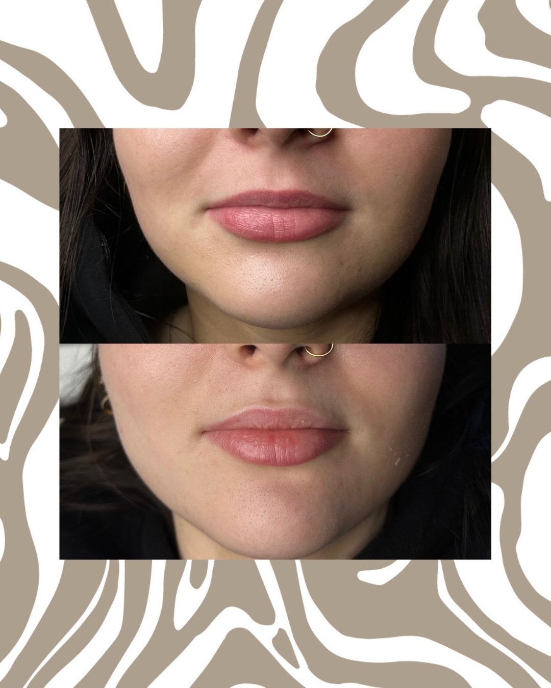 The Lip Flip ✨ ⁠
⁠
To achieve this subtle yet effective result a small amount of botox is used to slightly relax the muscle above the lip resulting in a fuller look to the the top lip! ⁠
⁠
This is a great option for clients with ample amount of lip t