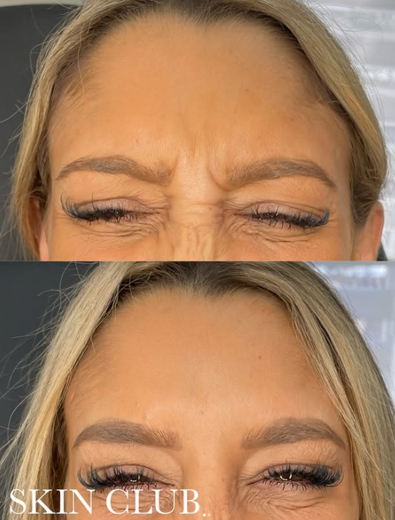 Botox 101: What to Expect, How It Works, and Common Myths