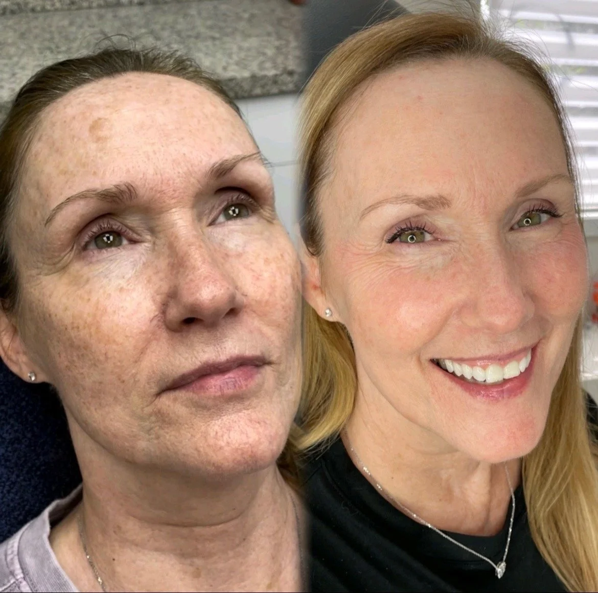 Brown Spot Treatment: How to Get a More Even, Radiant Complexion