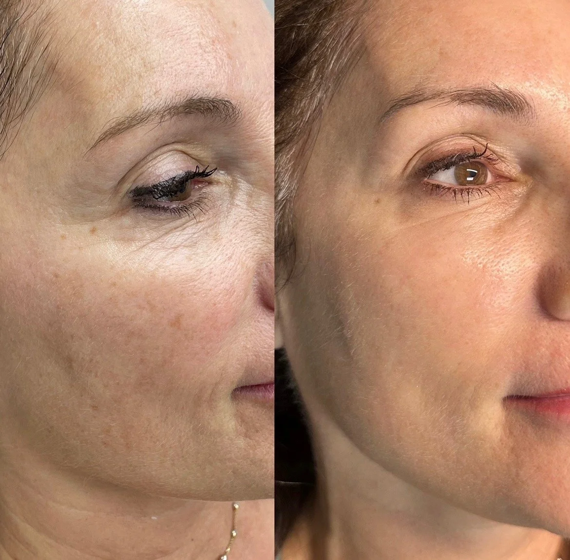 Fractionated Laser Treatment: A Powerful Solution for Brown Spots, Fine Lines, and Uneven Skin