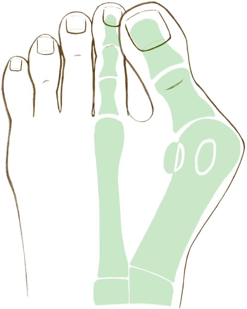 Bunion