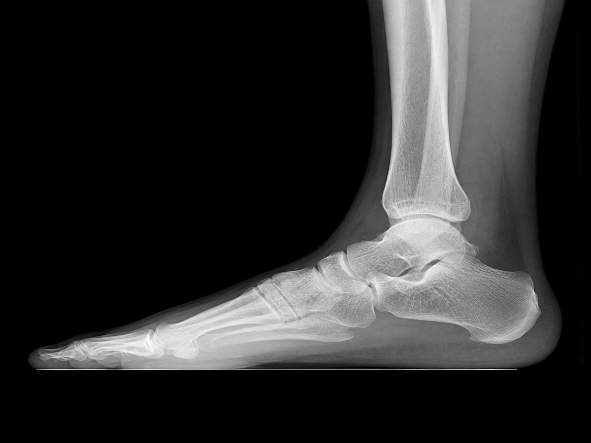 Foot Xray.png