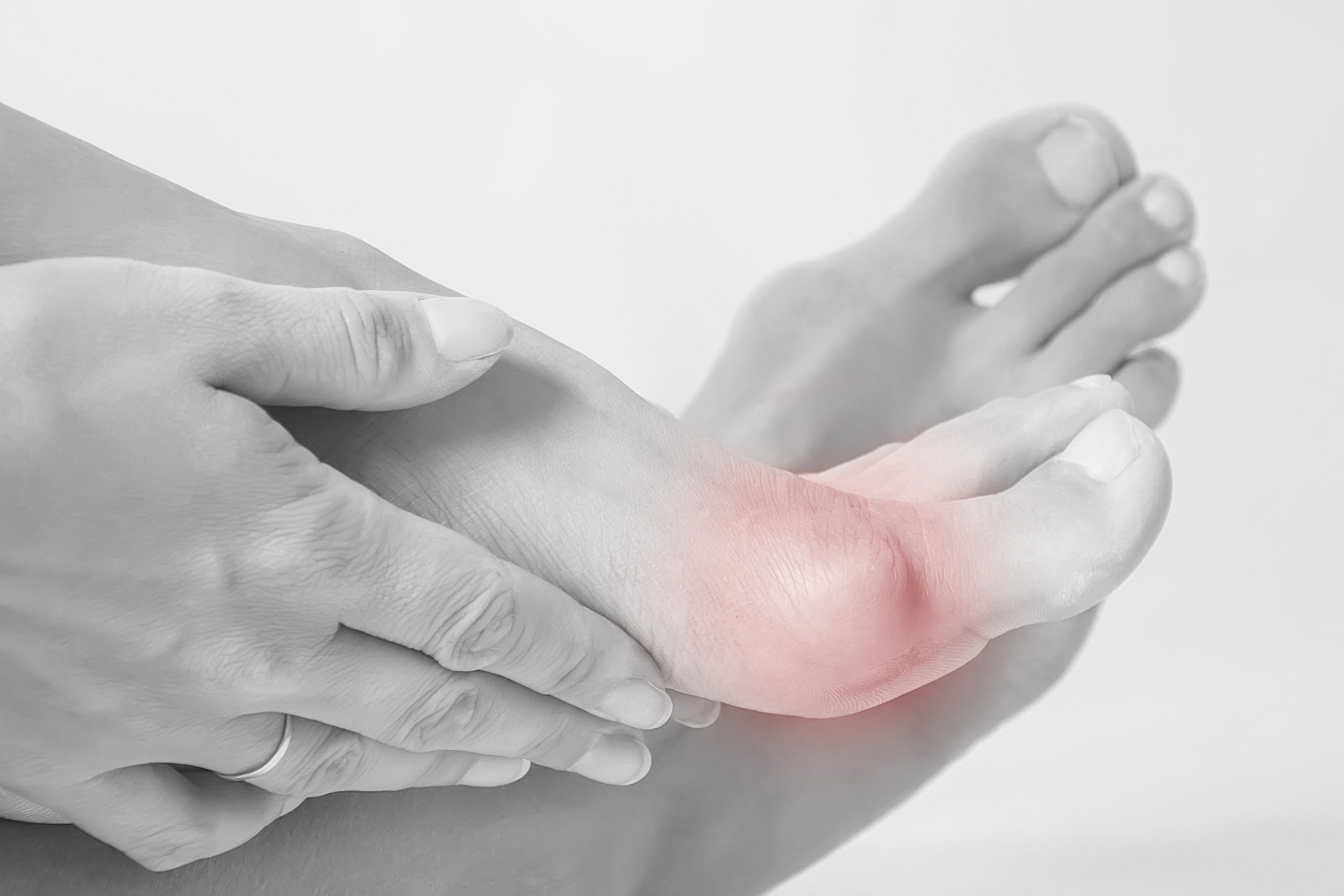 Bunion 1.jpg