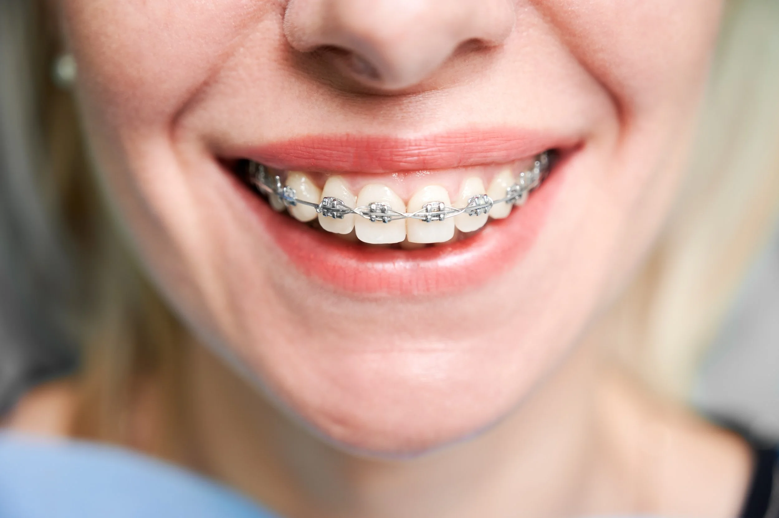 ¿Es normal que se muevan los dientes con ortodoncia?