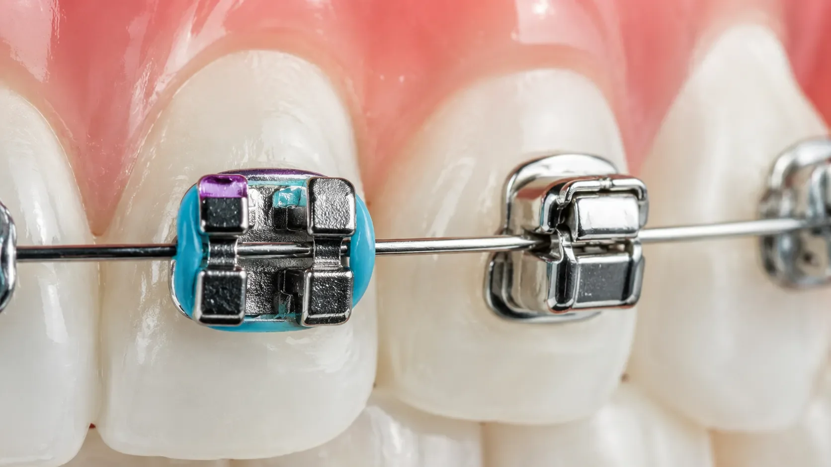Brackets de autoligado vs tradicionales: diferencias reales