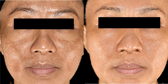 Melasma01.png