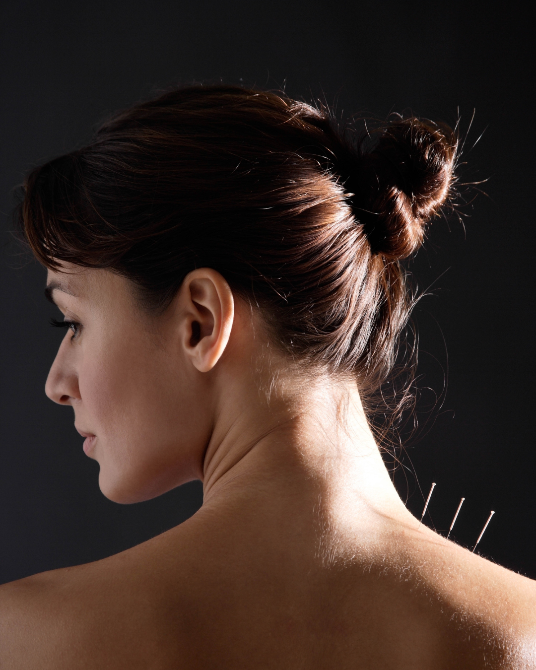 Acupuncture and Endometriosis: Understanding Its Role in Holistic Care