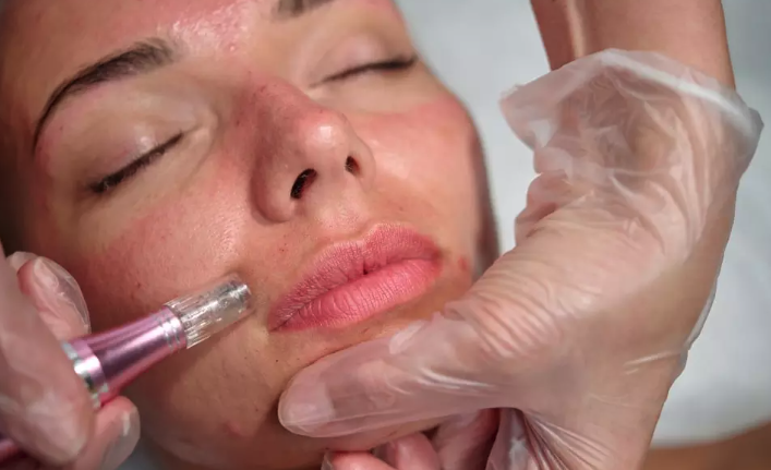 Basic Microneedling