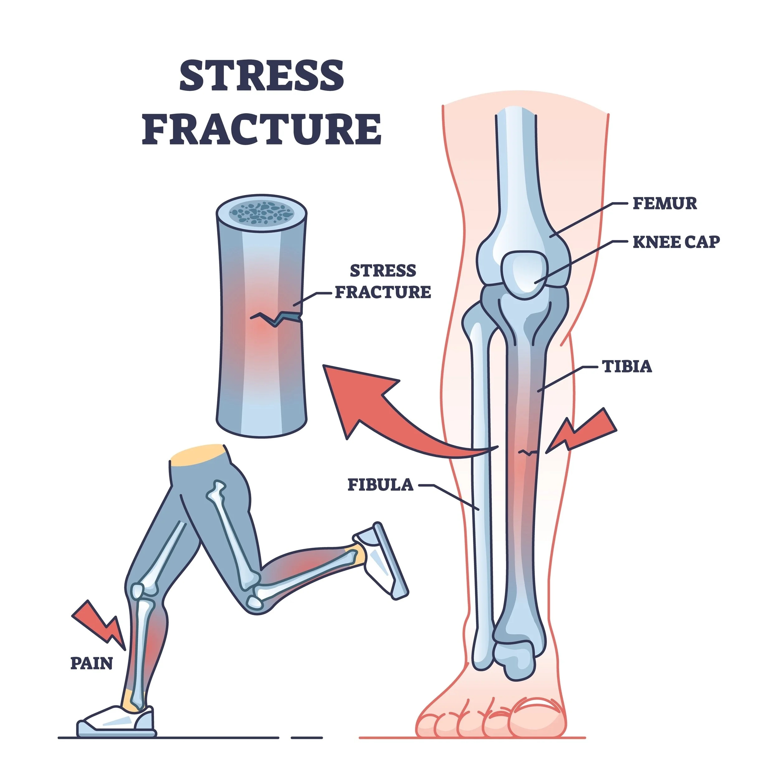 Diagram showing stress fracture in a bone, with illustrations of a knee joint including femur, knee cap, tibia, fibula, and a human leg with pain indicating a stress fracture.