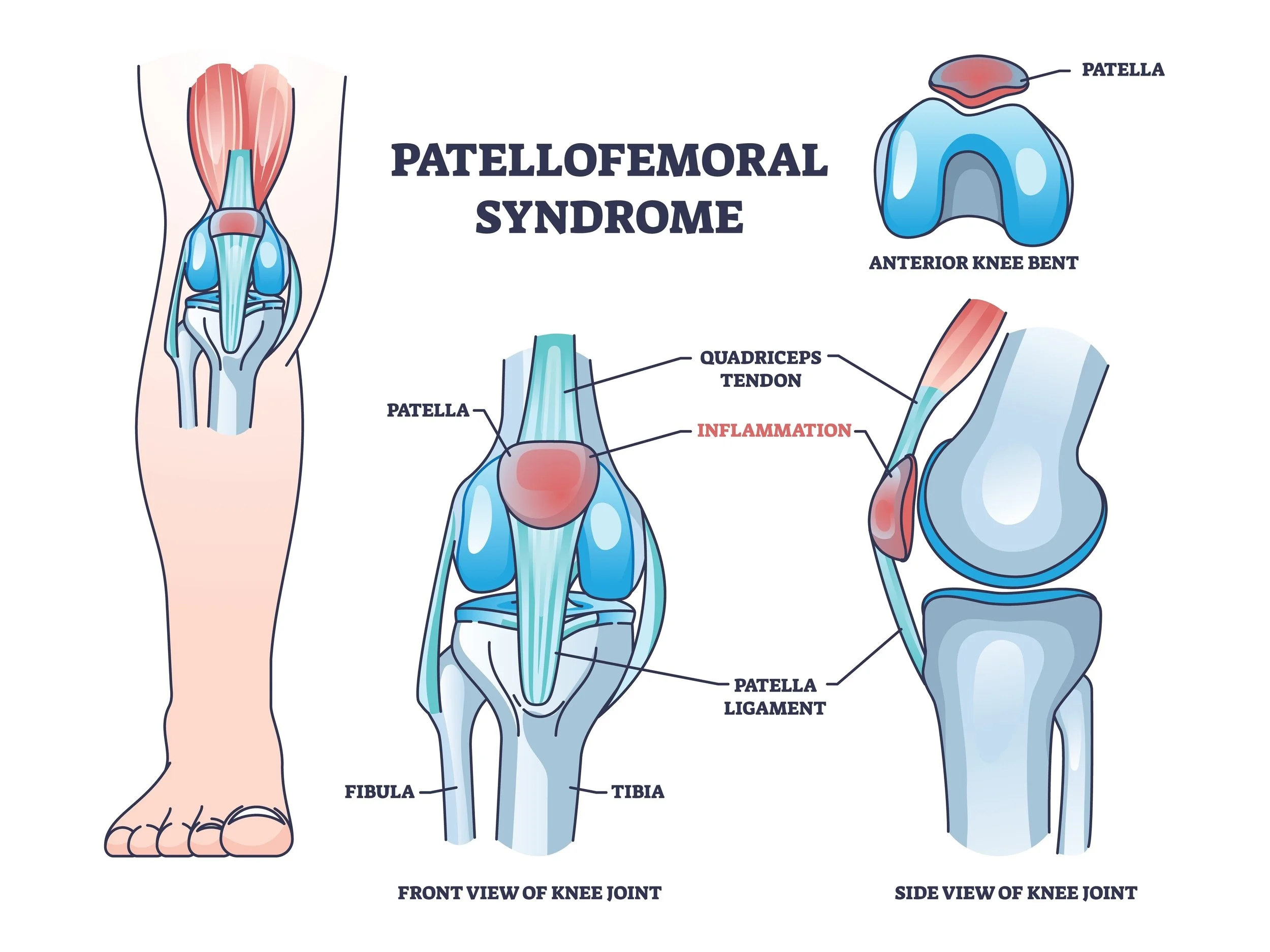 Diagram of knee joint showing patella, quadriceps tendon, quadriceps muscle, patella ligament, tibia, fibula, and inflammation on the knee indicating patellofemoral syndrome.