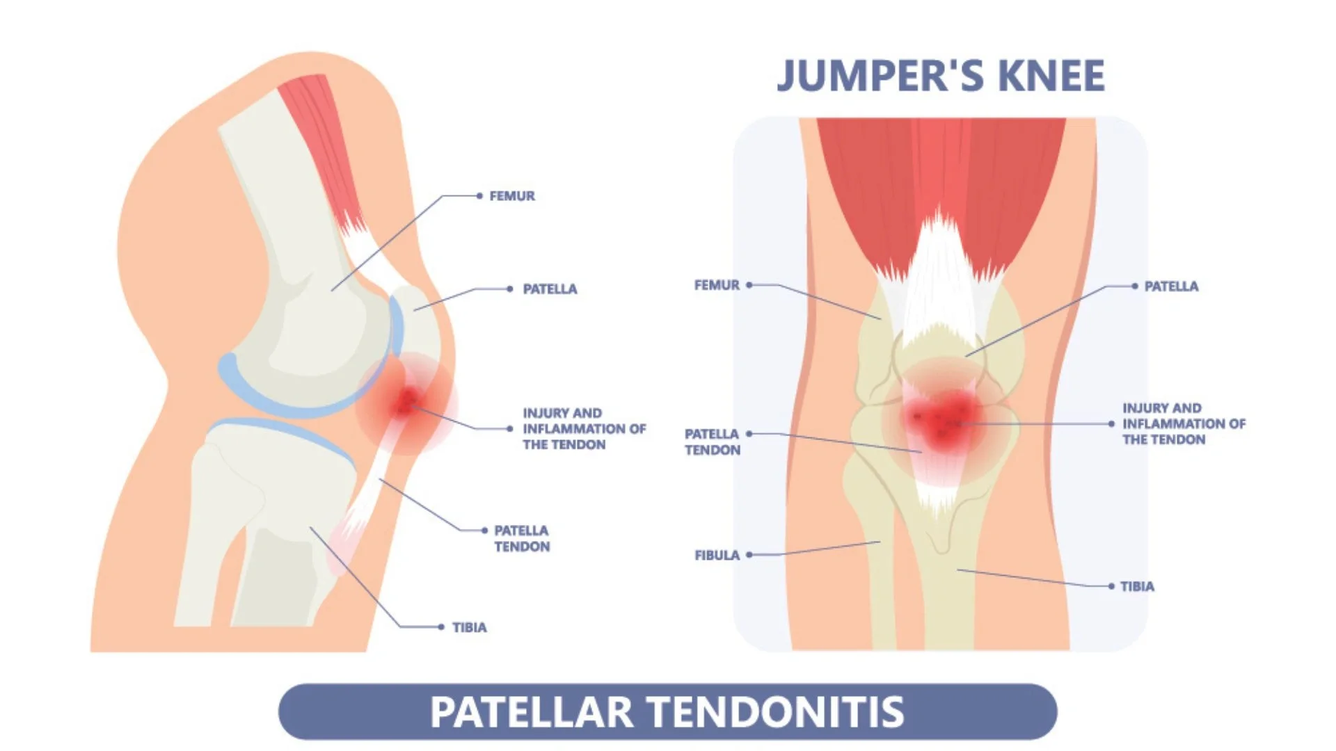 Diagram of patellar tendinitis showing inflammation and injury on the knee joint, with labels indicating the femur, patella, patella tendon, injury area, tibia, and fibula.