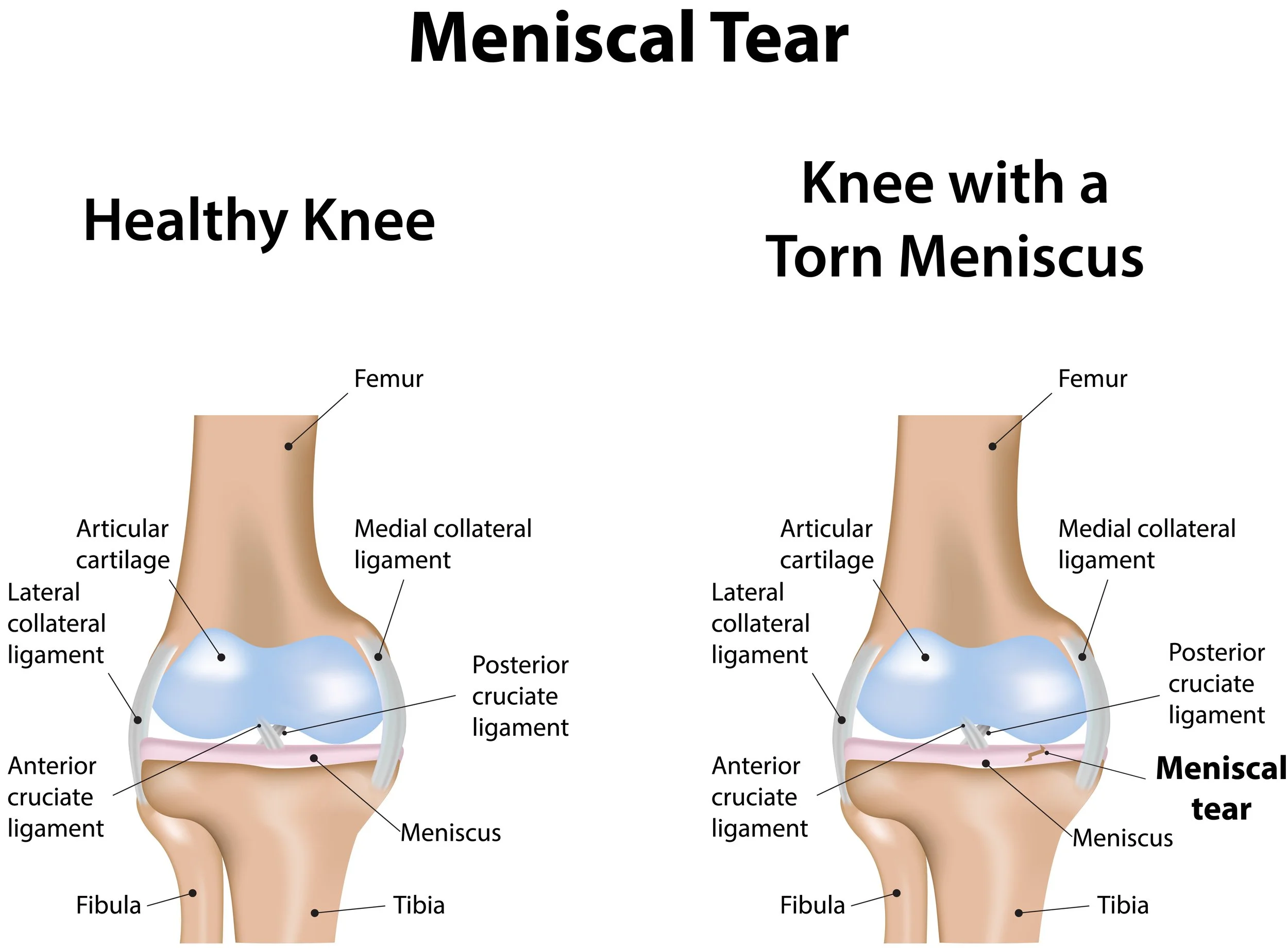 Diagram of a healthy knee and a knee with a torn meniscus, with labels for bones and ligaments. The healthy knee shows intact meniscus, while the torn meniscus knee indicates meniscal tear.