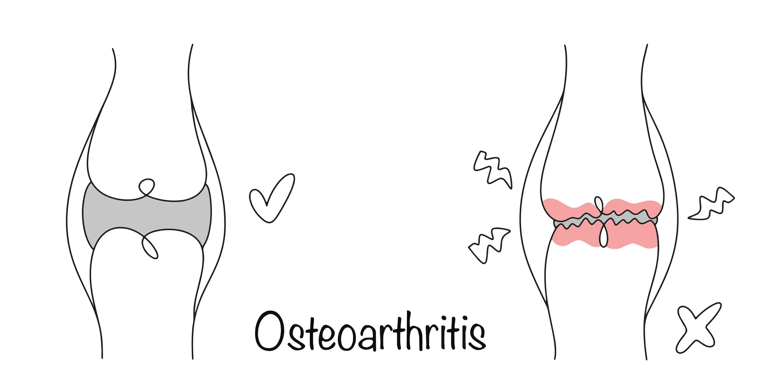 Comparison of healthy and osteoarthritis-affected knee joints, illustrating cartilage damage in osteoarthritis.