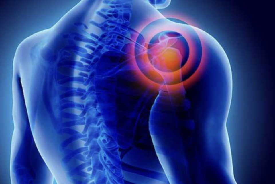 “Frozen Shoulder” Adhesive Capsulitis
