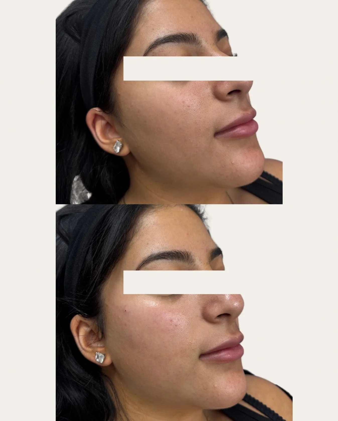 Subtle refinement enhancing what is already beautiful.
Every detail considered. Every feature respected.
#SydneyCityBeauty #BelmoreCosmeticClinic #SydneyAesthetics #SydneyBeauty  #AliraAesthetics
Disclaimer: This information is general in nature an