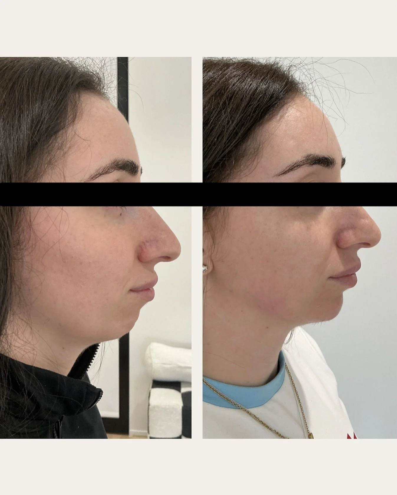 Subtle adjustments can create beautiful balance.
Every face tells its own story here, we worked on refining proportions while maintaining harmony and individuality. Book your complimentary consultation today 

#AliraAesthetics #YourBeautyYourPace
#Sy