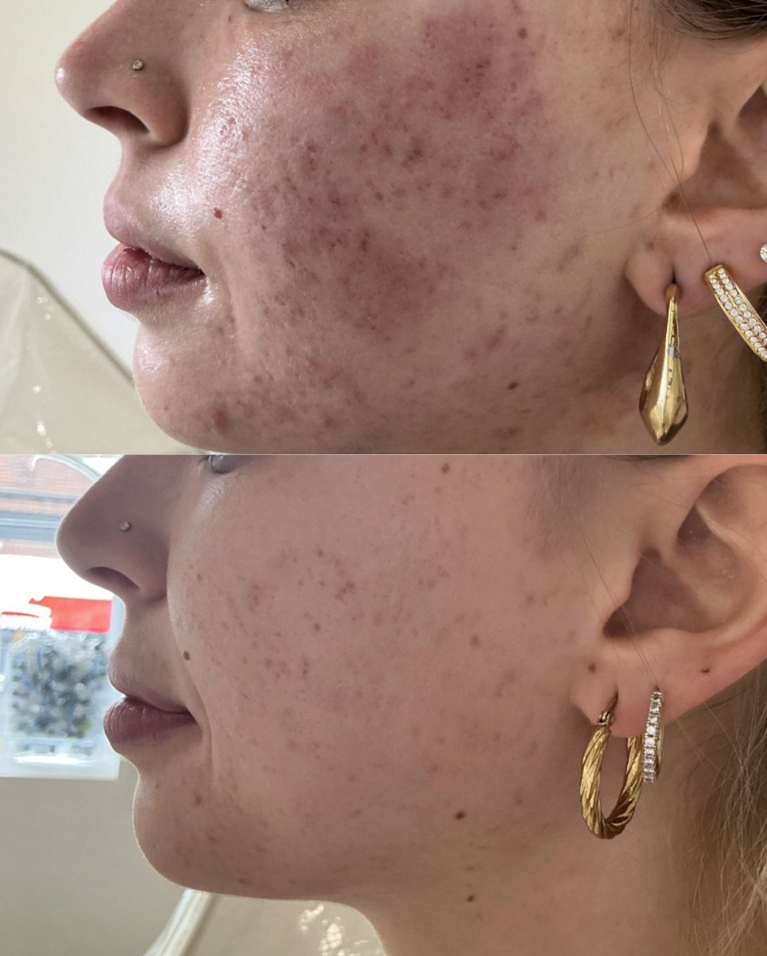 A common concern I see here in clinic is rosacea, uneven texture, acne scars, and a damaged skin barrier and feel like nothing is making a real difference. This client felt the same until we started her Rejuran journey.

This client completed her Rej