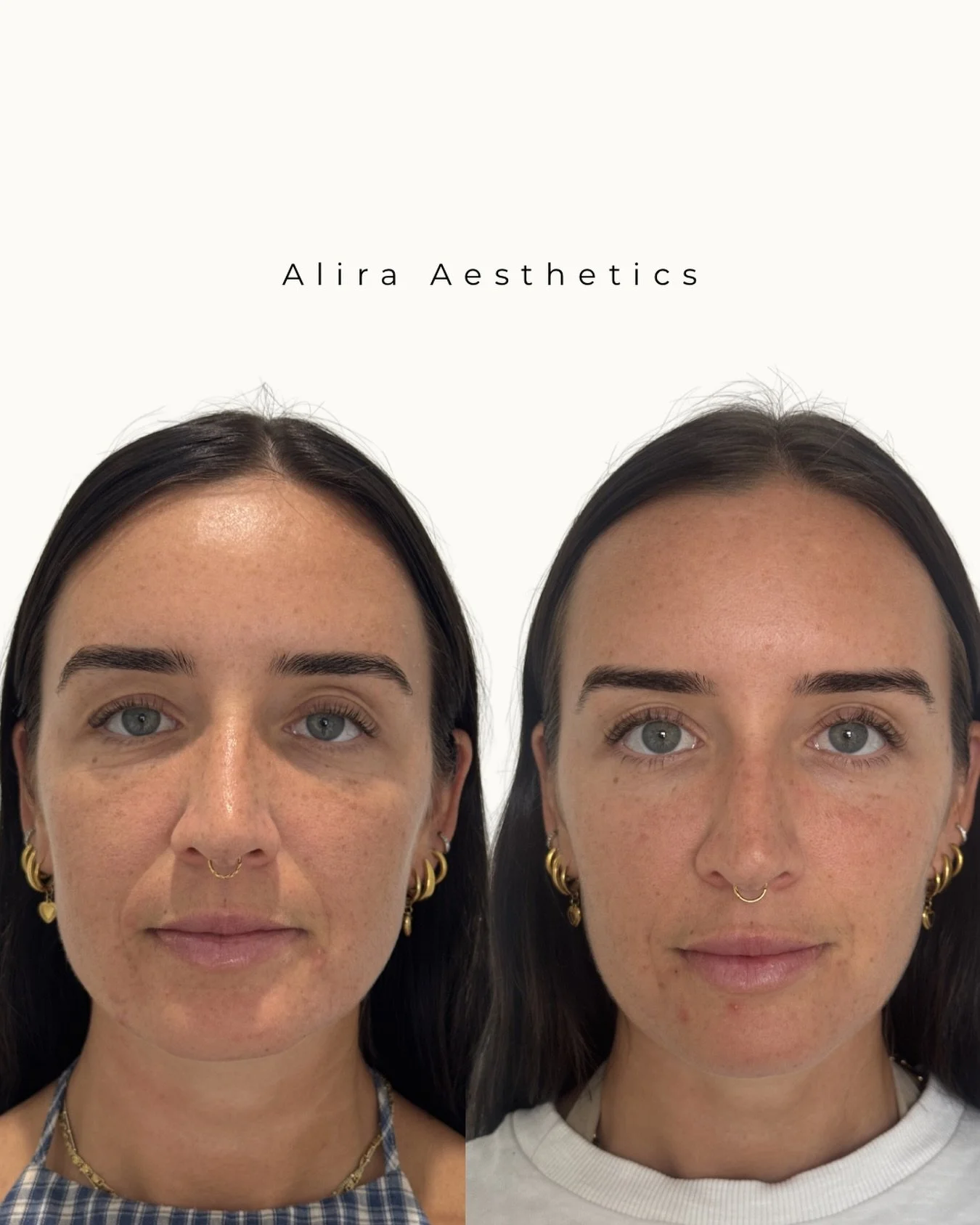 Name: Julia Vasilas
AHPRA Registration: NMW0002426035
Title: Registered Nurse
Clinic: Alira Aesthetics 
Location: Belmore 

Disclaimer: This information is general in nature and provided for educational purposes only. It is not a substitute for medic