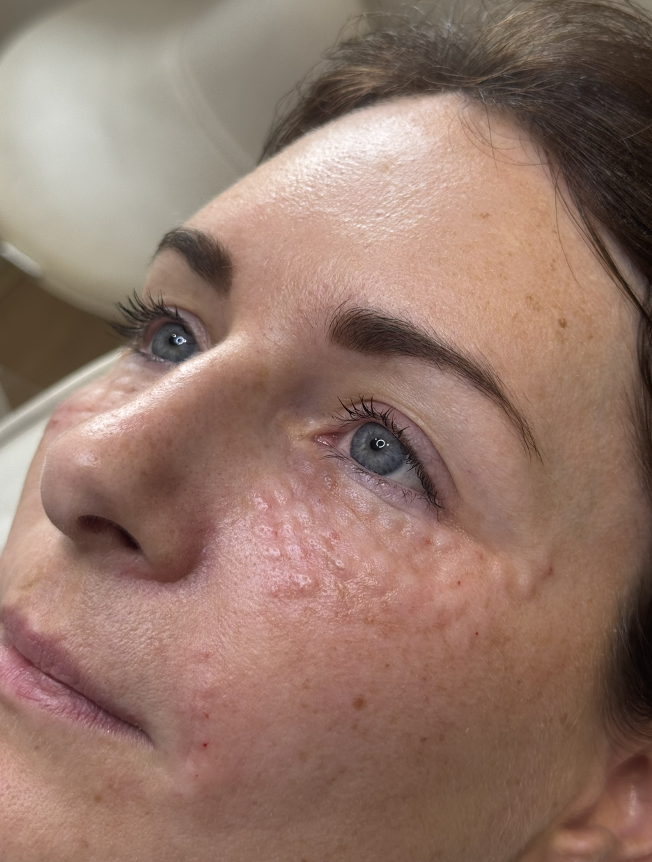 Skin Rejuvenation Treatments