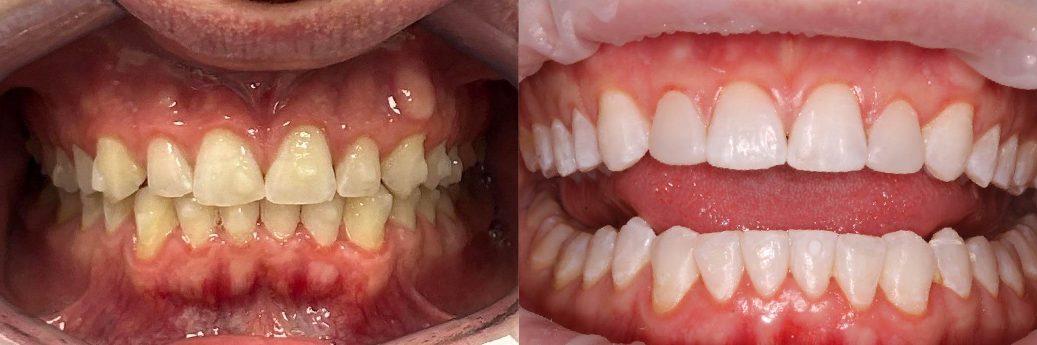 JME_Before & After Images_Invisalign_Teeth Whitening_Composite Bonding 2 - 9mths.jpg