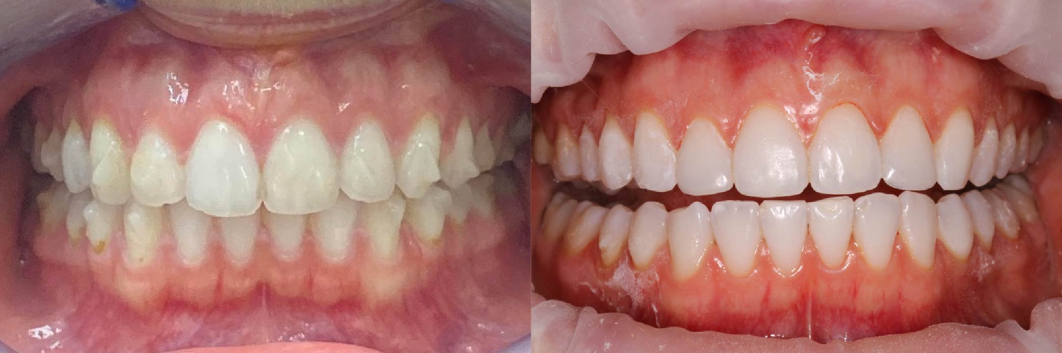 JME_Before & After Images_Invisalign_Teeth Whitening_Composite Bonding 3-03.jpg