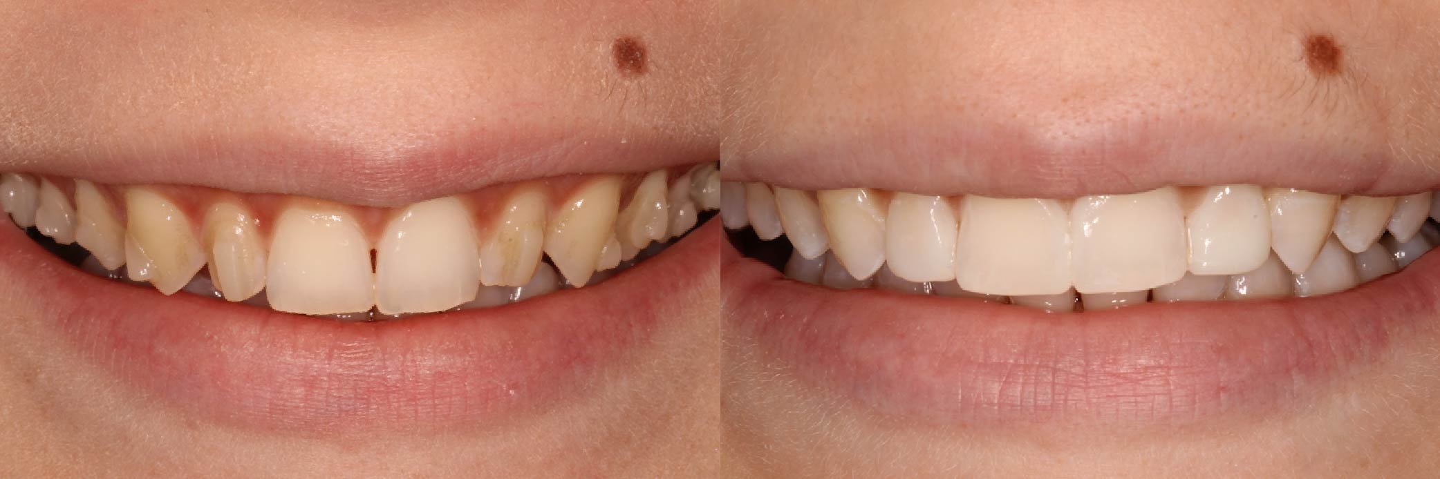 JME_Before & After Images_Invisalign_Teeth Whitening_Composite Bonding 4-04.jpg