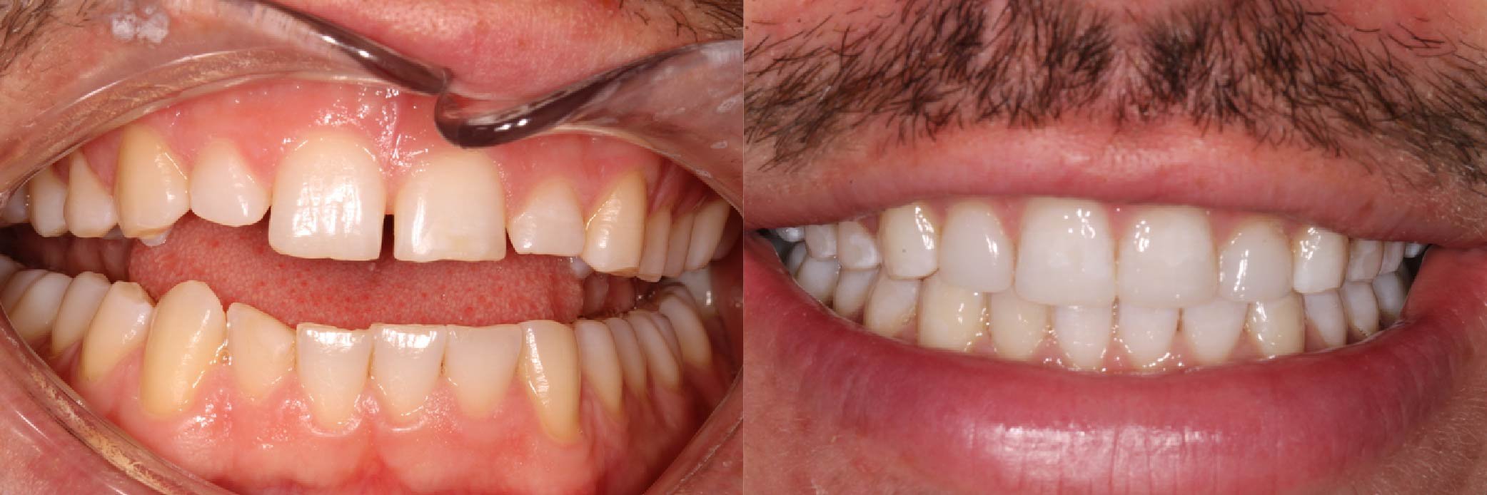 JME_Before & After Images_Invisalign_Teeth Whitening_Composite Bonding 5-05.jpg