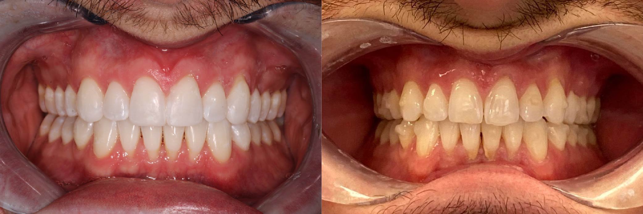 JME_Before & After Images_Invisalign_Teeth Whitening_Composite Bonding-01.jpg
