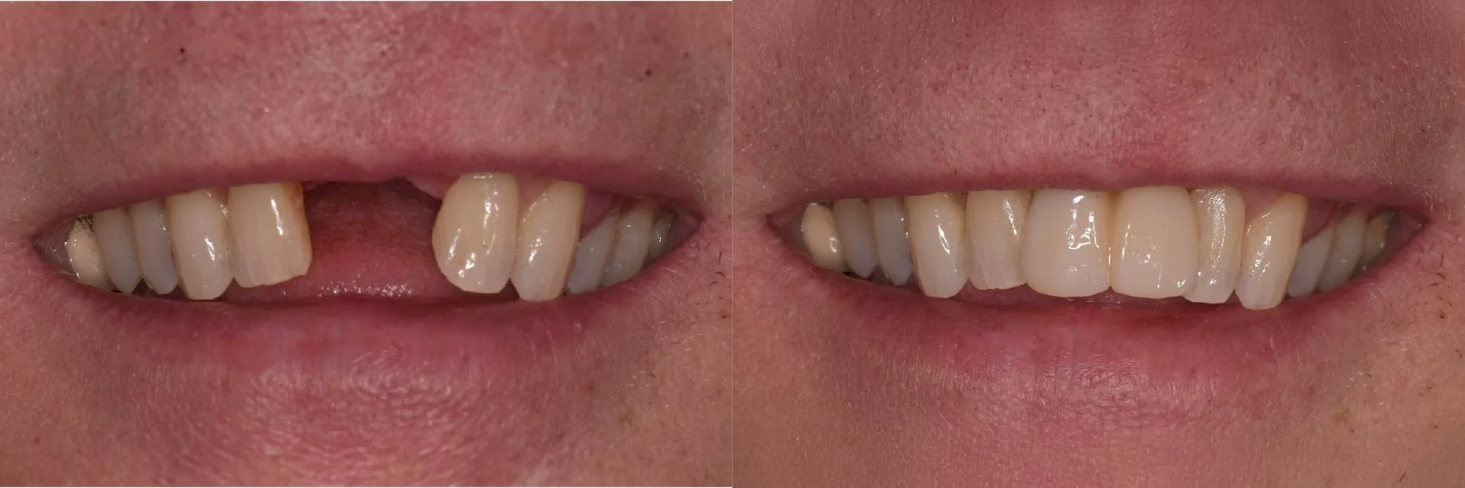 JME_Before & After Images_Implants-06.jpg