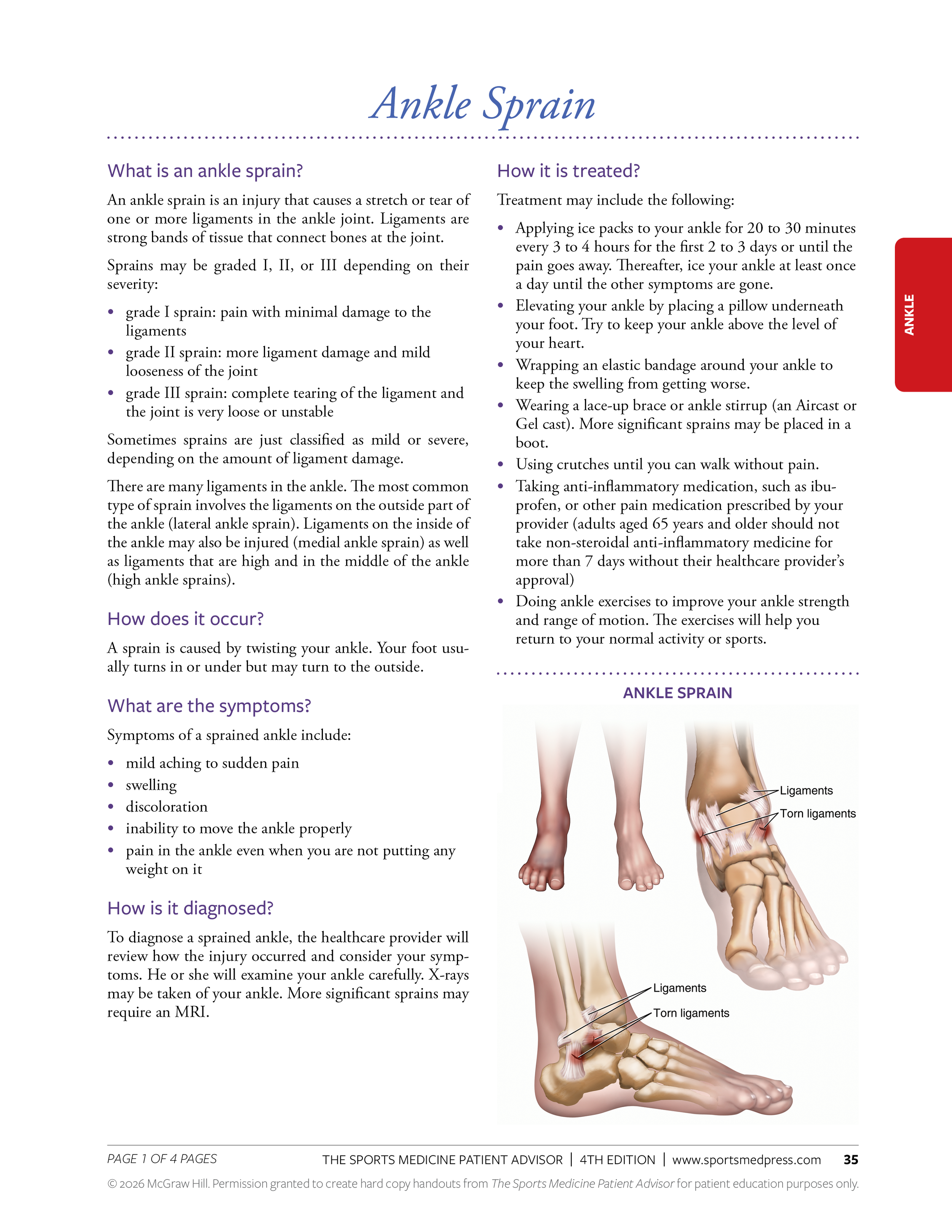 Diagram of an ankle showing ligaments and torn ligaments, labeled as part of an educational page about ankle sprains.