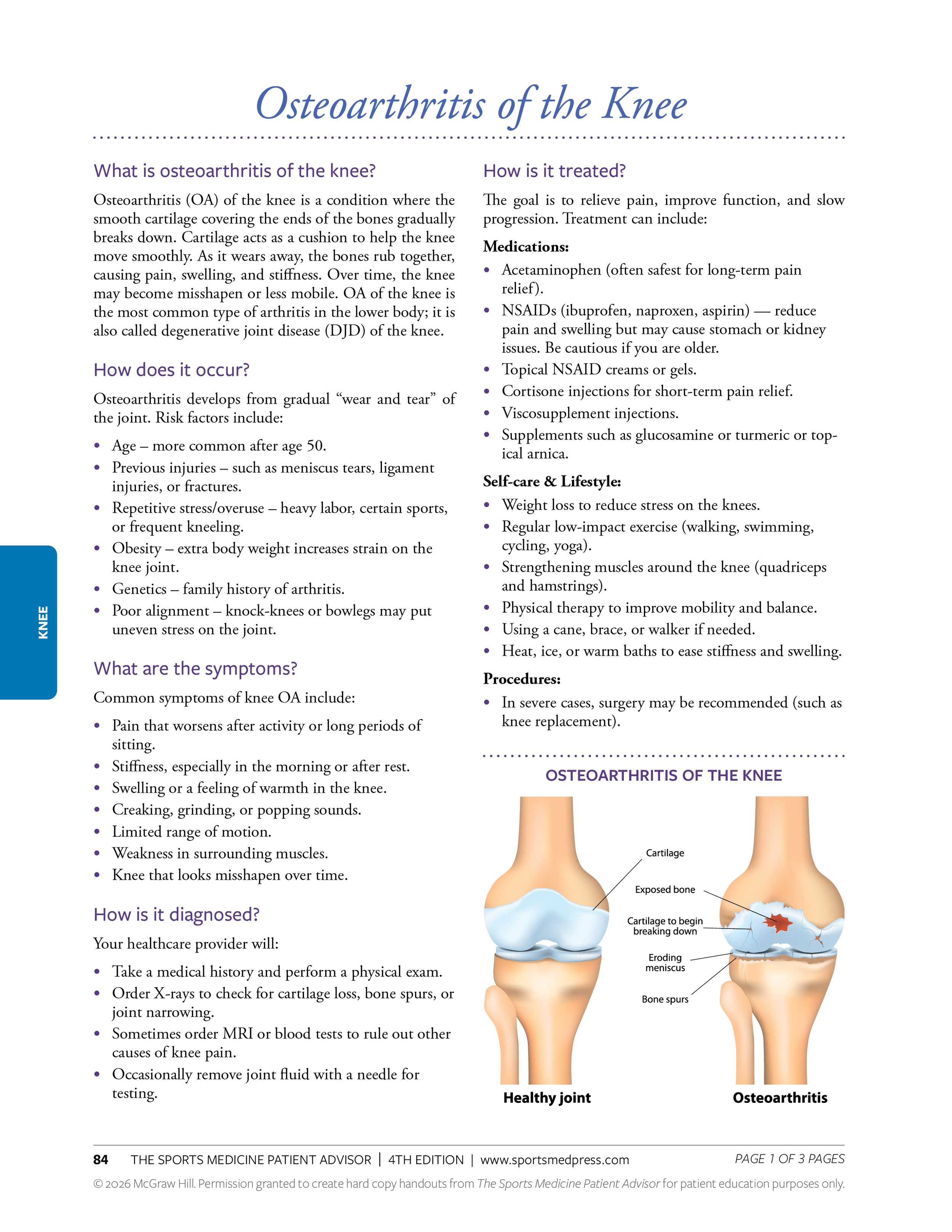 Diagram comparing a healthy knee joint with a knee affected by osteoarthritis, showing cartilage deterioration, exposed bone, and eroding meniscus.