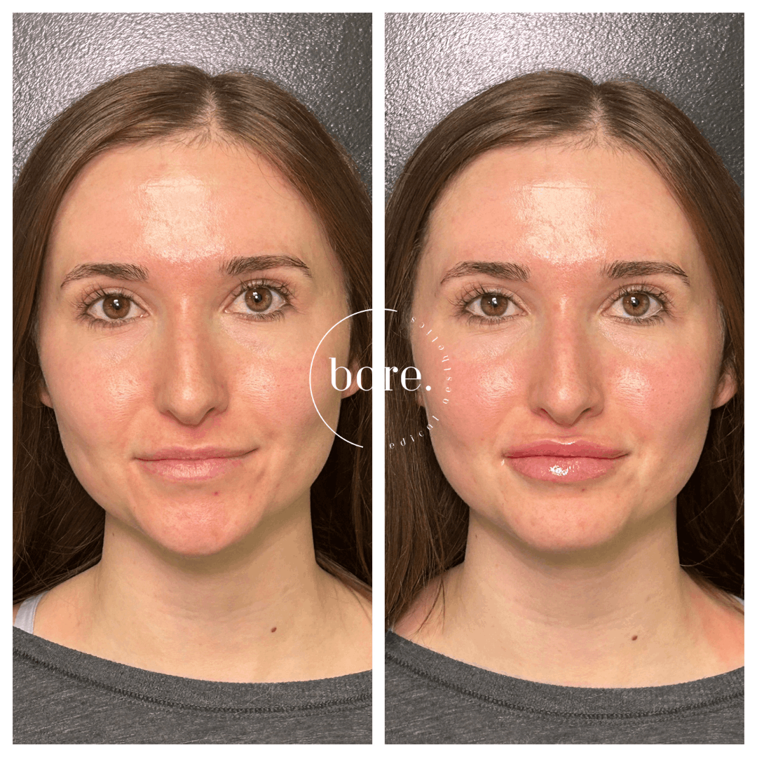 Lip Filler (3).png