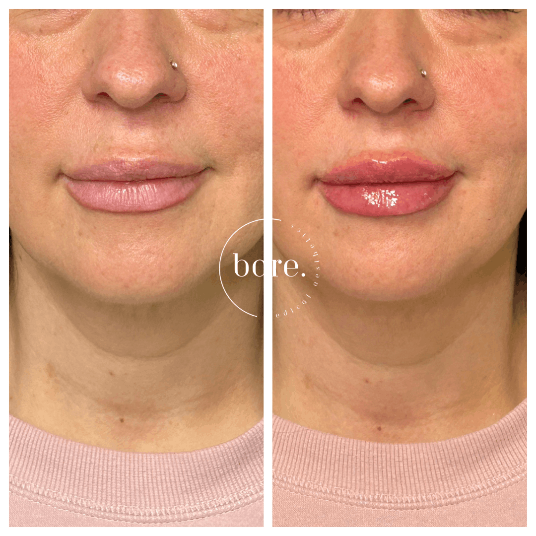 Lip Filler (5).png
