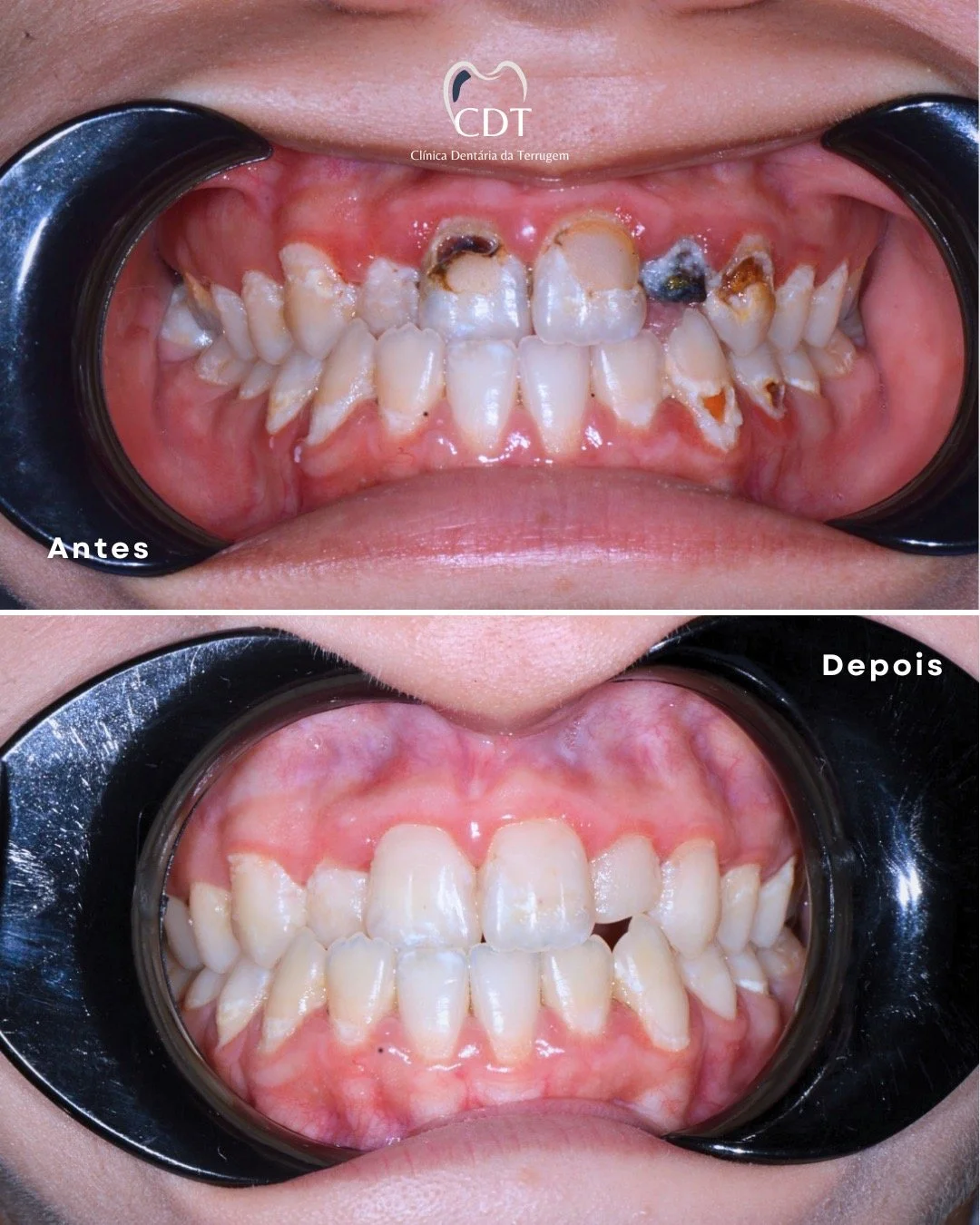 Fotos comparativas dos dentes de uma pessoa antes e depois de um tratamento odontológico, mostrando melhora na saúde bucal e na aparência dos dentes.