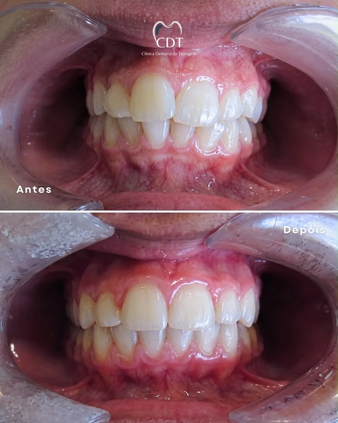 Fotos de dentes antes e depois de tratamento odontológico, mostrando melhora na saúde bucal