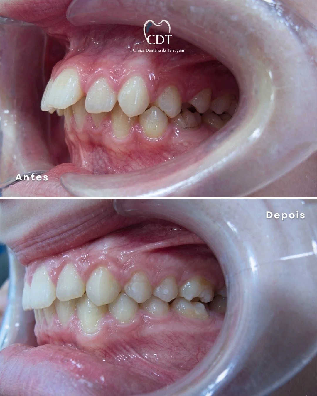 Fotos de antes e depois de um tratamento odontológico, mostrando melhoria na aparência dos dentes.