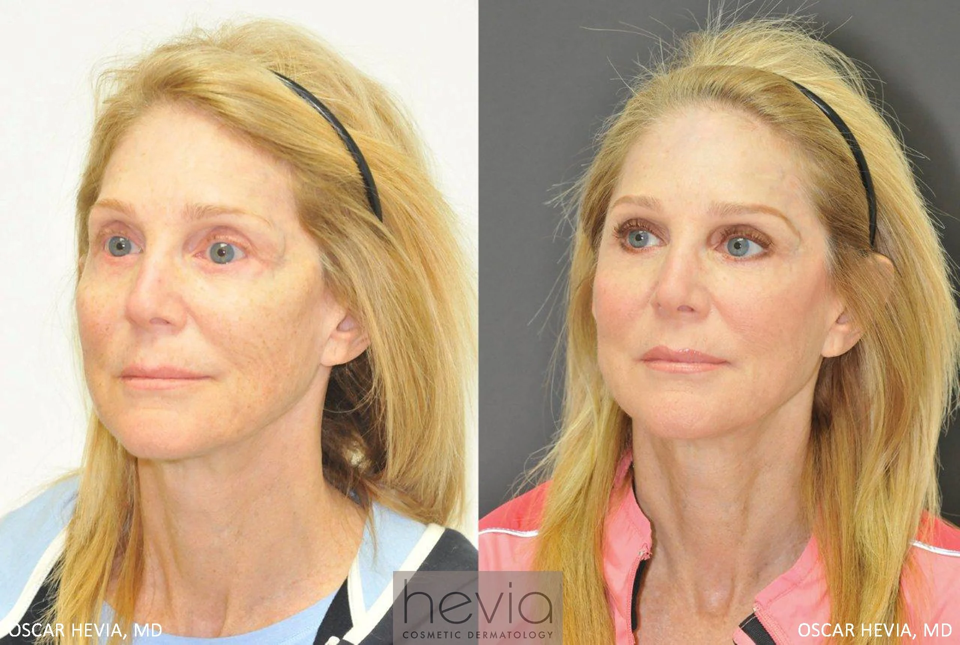Refreshed and more youthful appearance after Radiesse® and Restylane® to upper and lower face.
