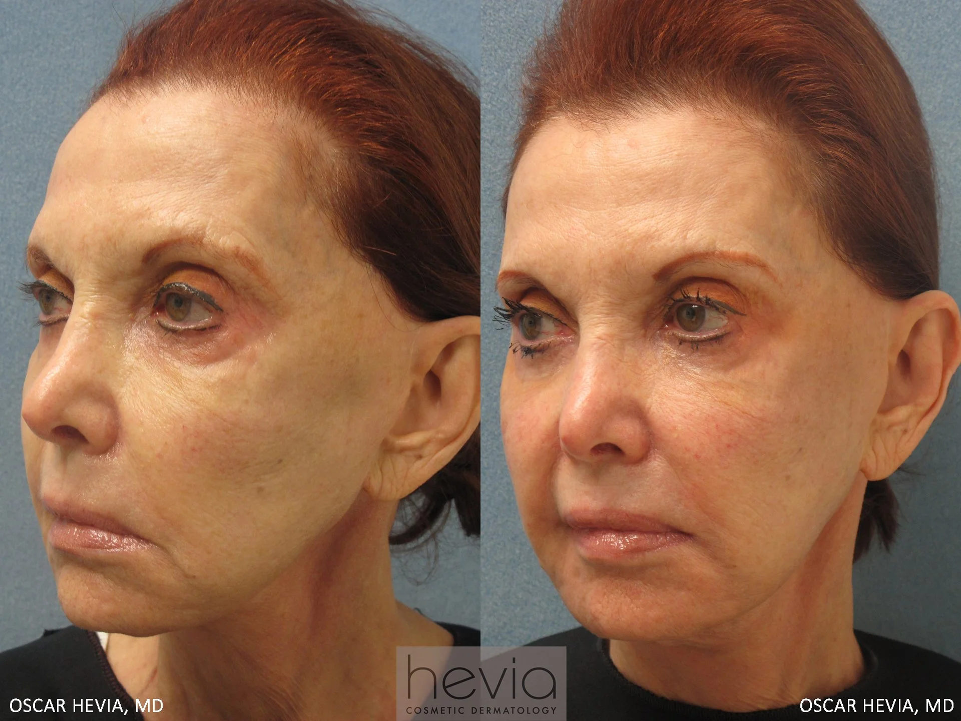 Refreshed, more youthful appearance after Restylane® treatment around the eyes and cheeks.