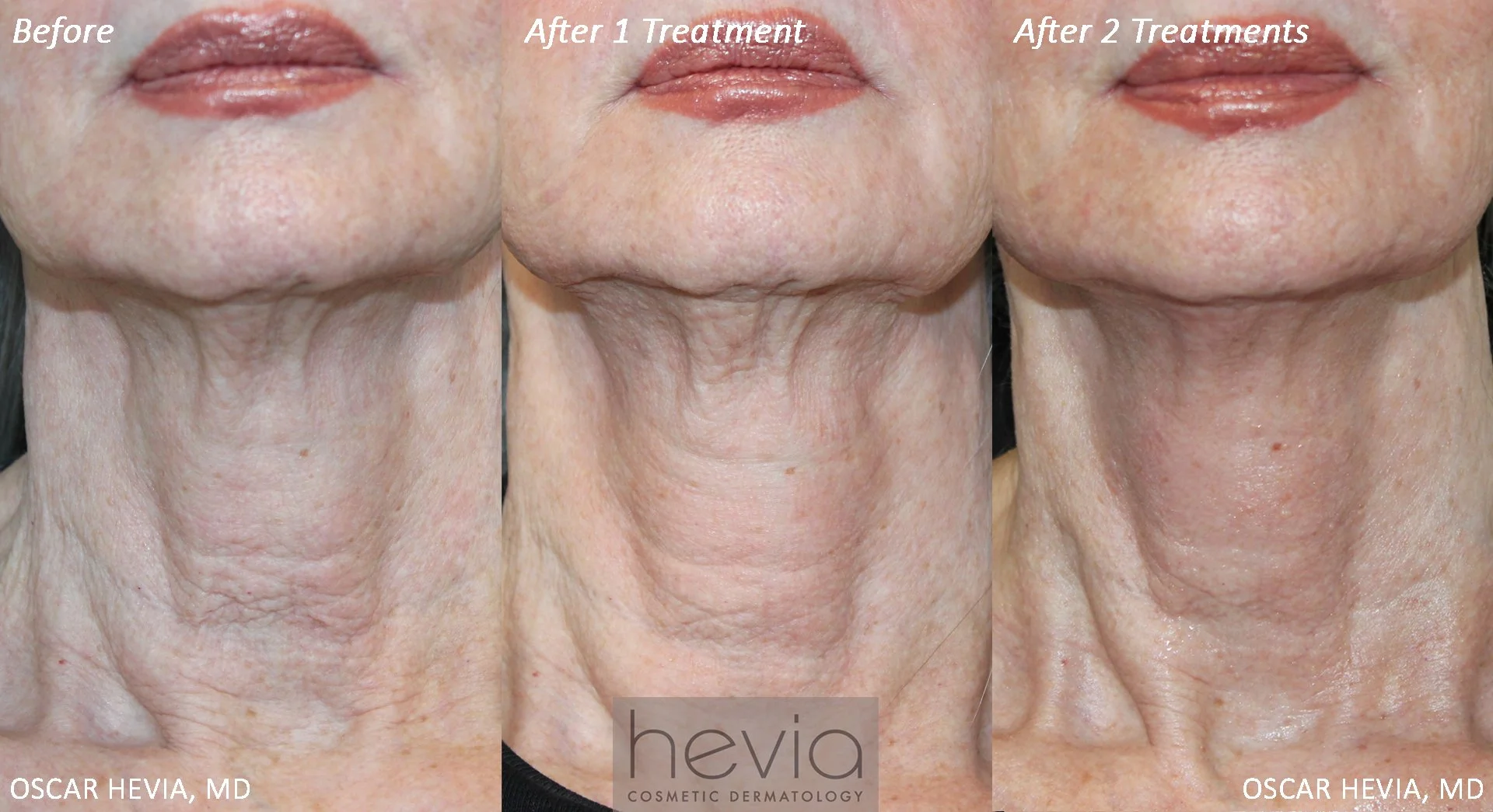 75 year old patient with neck, jowl & jawline skin laxity and texture issues.