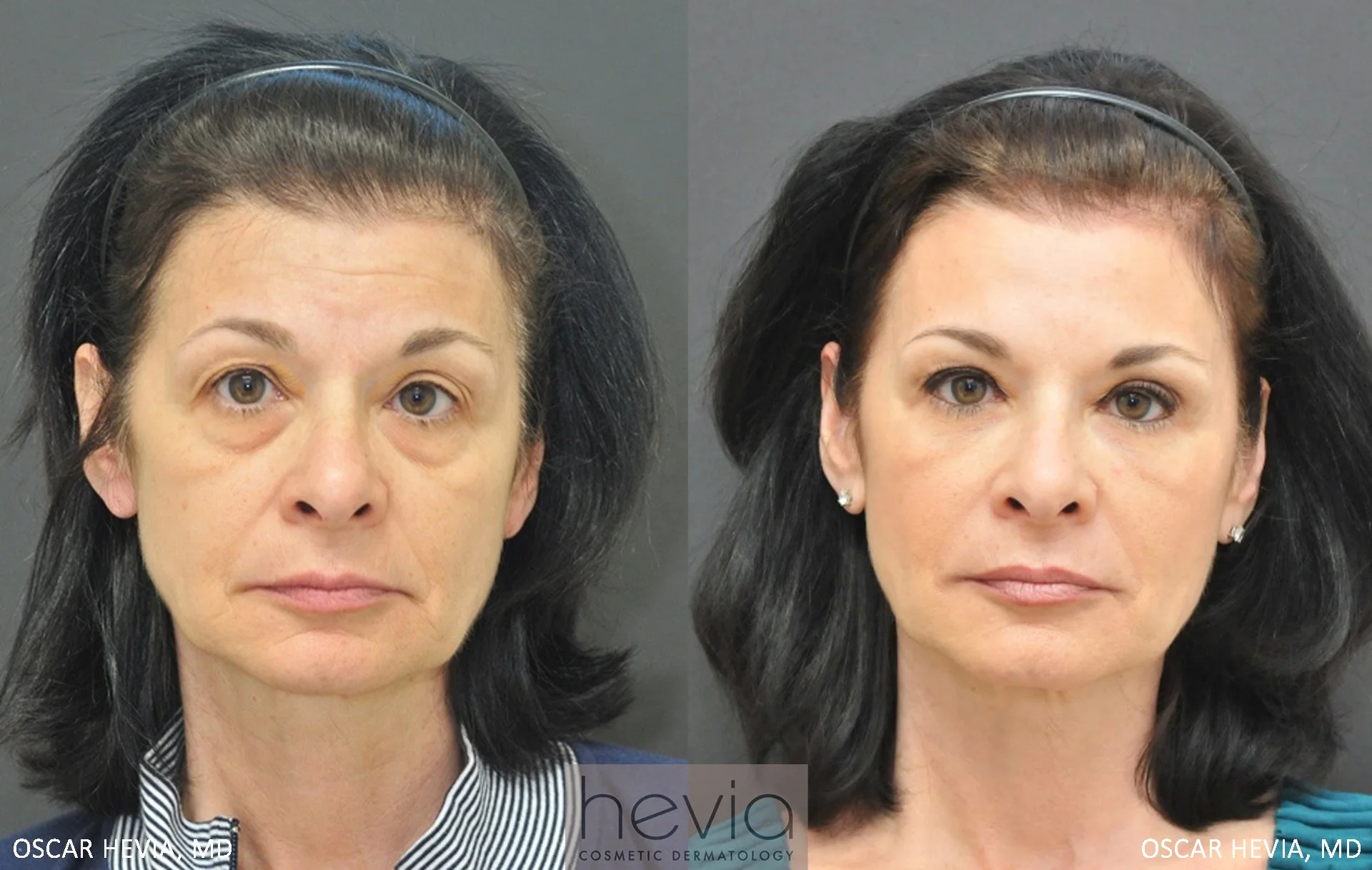 55 year old female with Radiesse® and Restylane® to upper and lower face