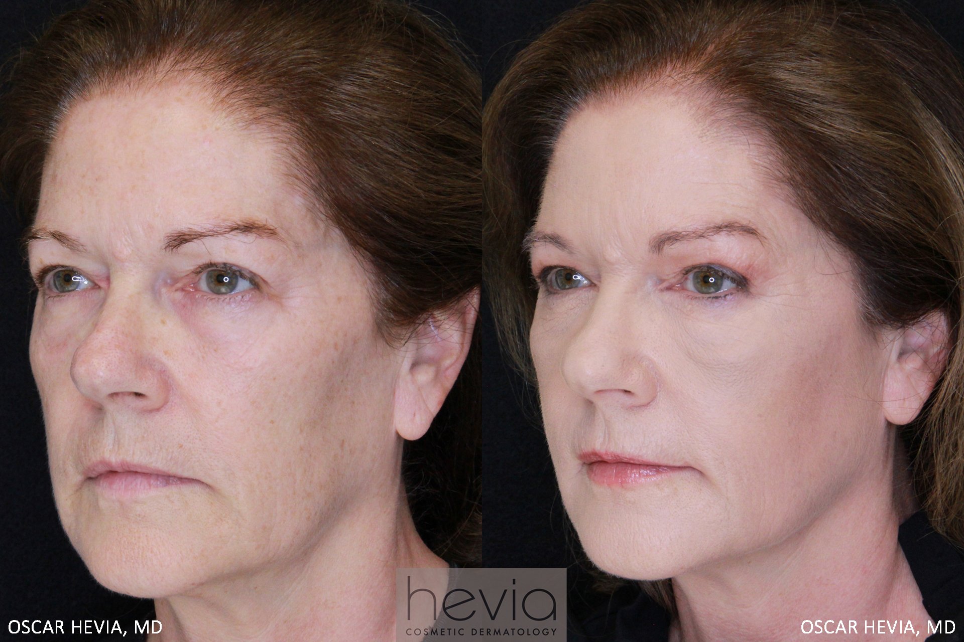 63 year old female with a refreshed and more youthful appearance after Bellafill® filler treatment to the upper & lower face and Botox® treatments for the forehead & frown lines