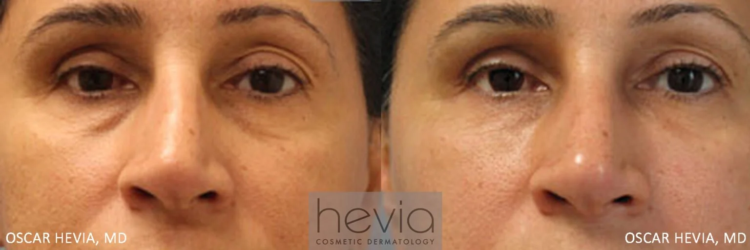 Refreshed, more youthful appearance after Restylane® treatment around the eyes and cheeks.
