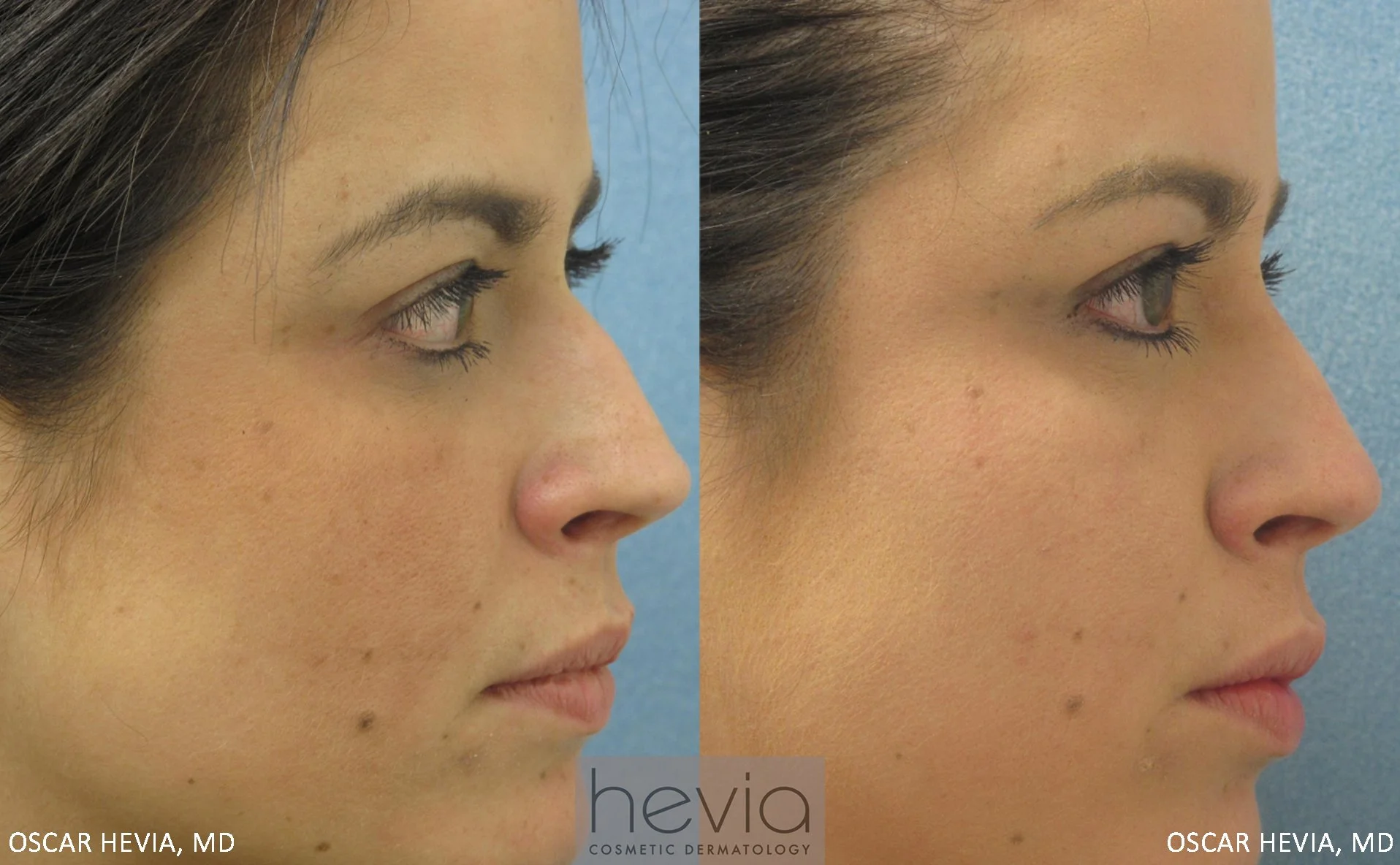 Correction of nasal bump with Restylane® injectable filler treatment.