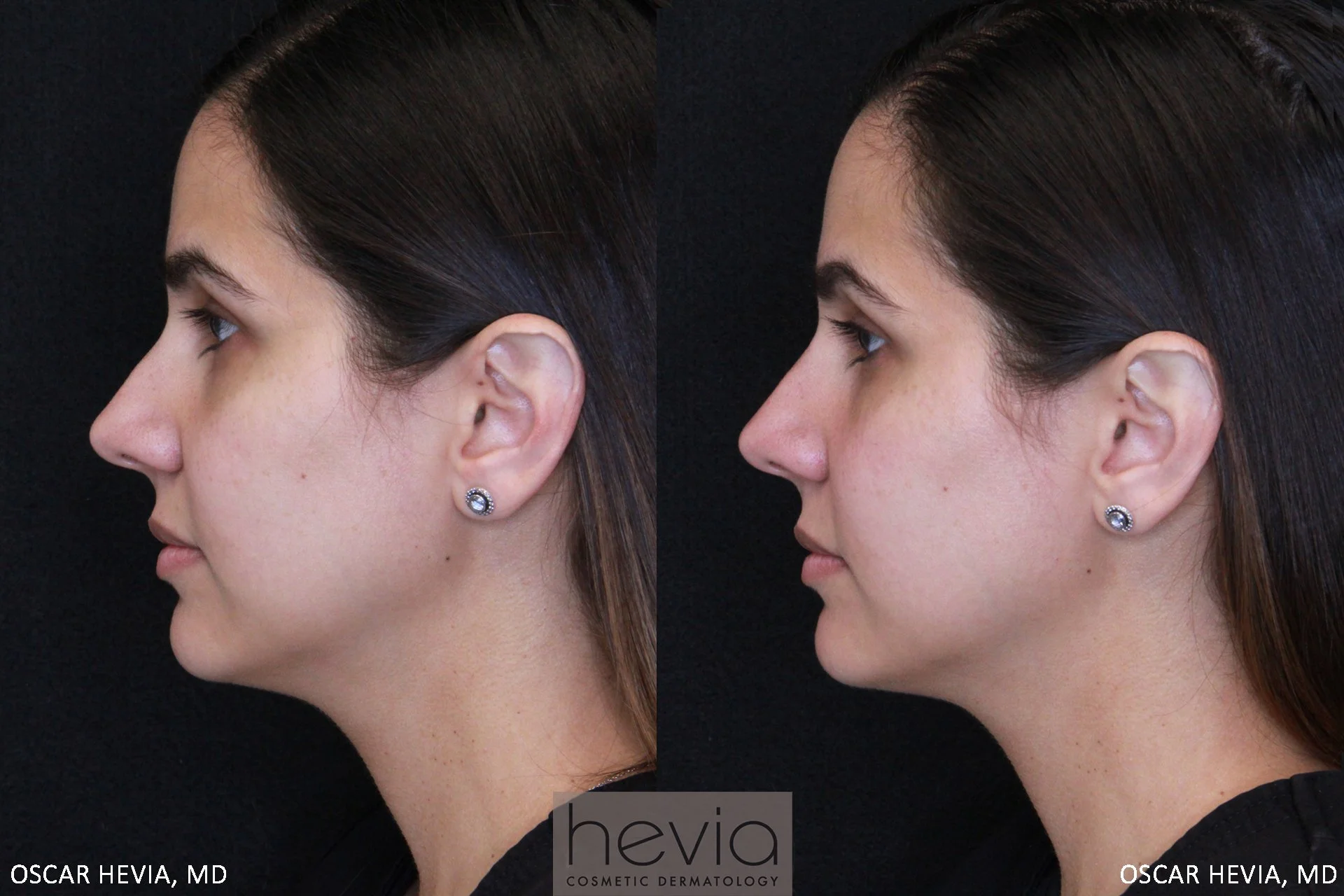 Correction of nasal bump with Vollure™ XC injectable filler treatment.