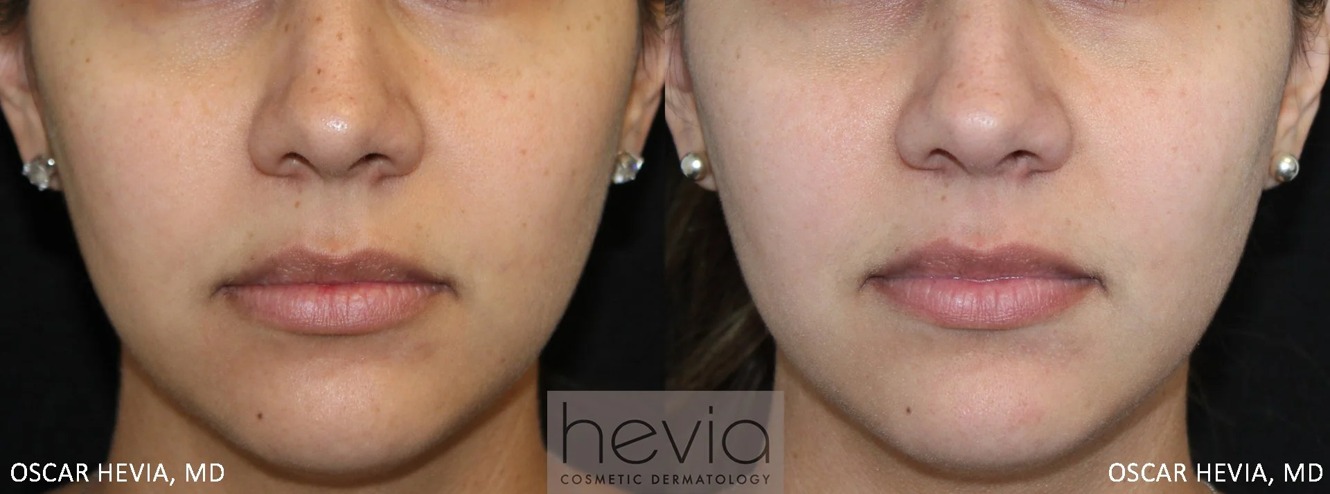 Fading of brown spots after KTP laser.