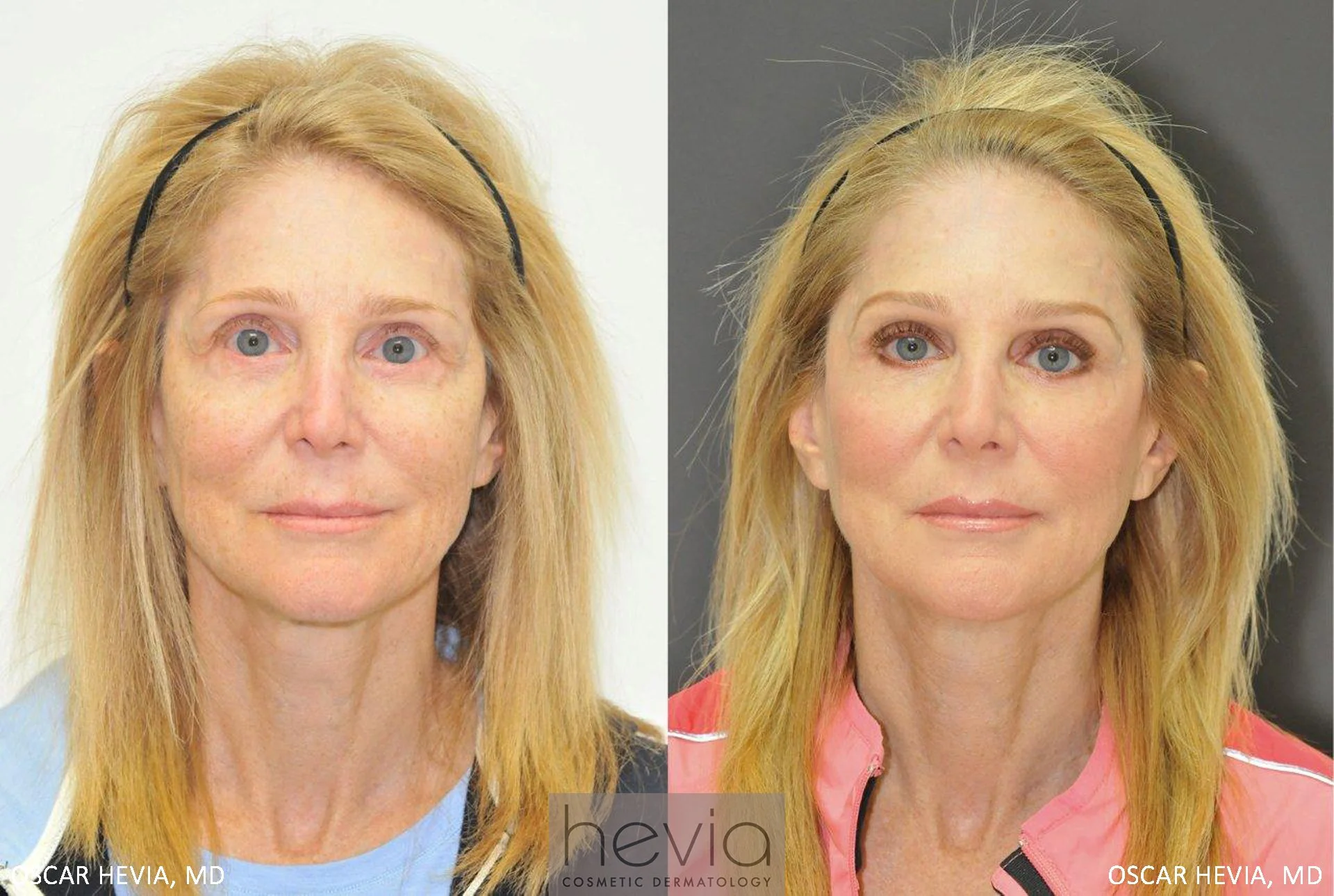 Refreshed and more youthful appearance after Radiesse® and Restylane® to upper and lower face.