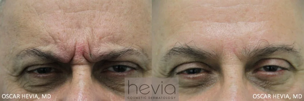 1Botox-Male-before-and-after-4-1024x341.jpg