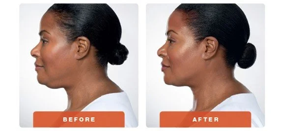 Patients above experienced visible contouring of their chin profile in 2 to 4 treatments.