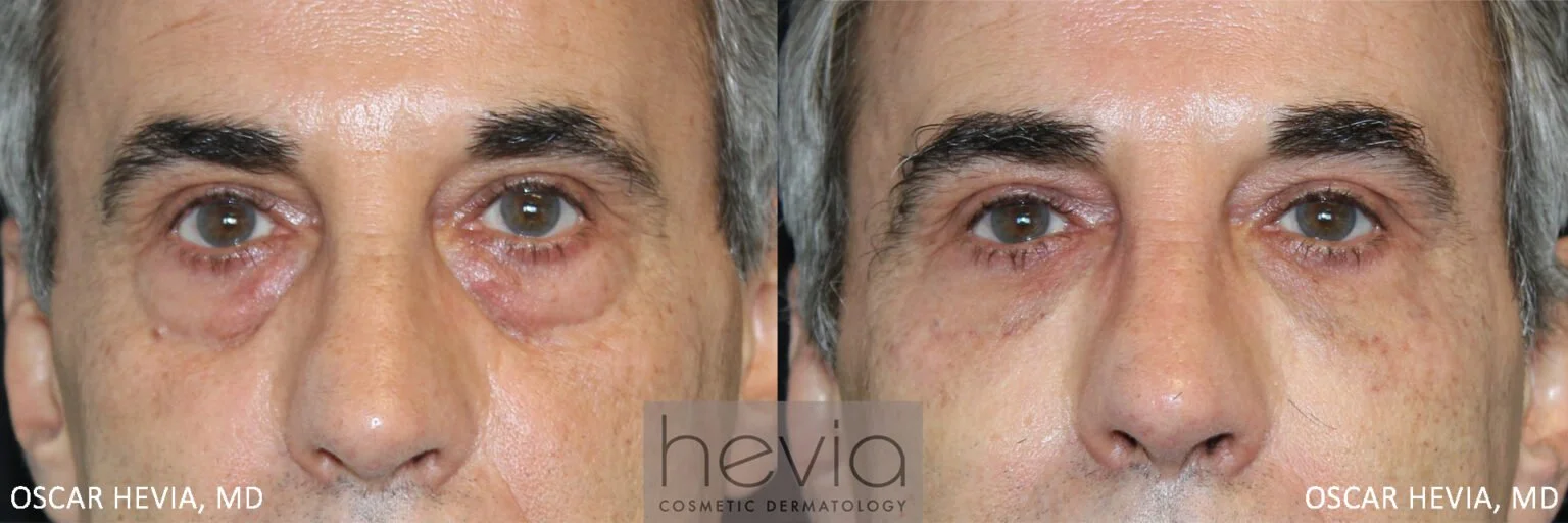 63 year old male after under eye filler correction.